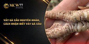 Vảy Gà Xấu | Nguyên Nhân, Cách Nhận Biết Vảy Gà